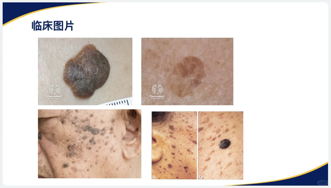 【皮肤病理分享——脂溢性角化病】