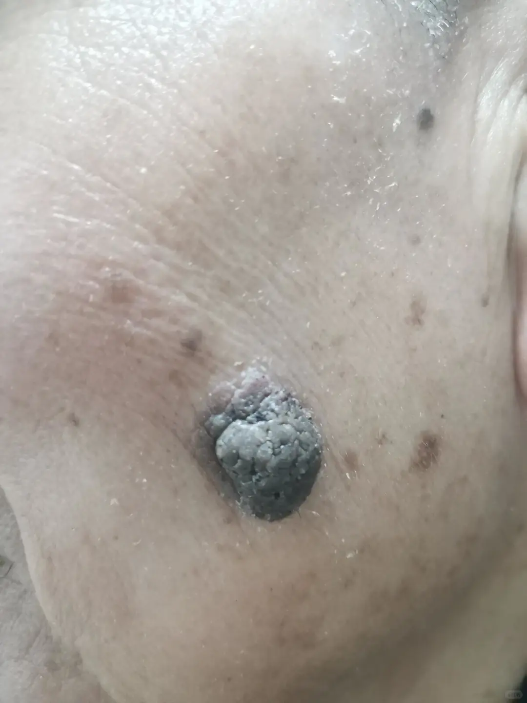脂溢性角化病