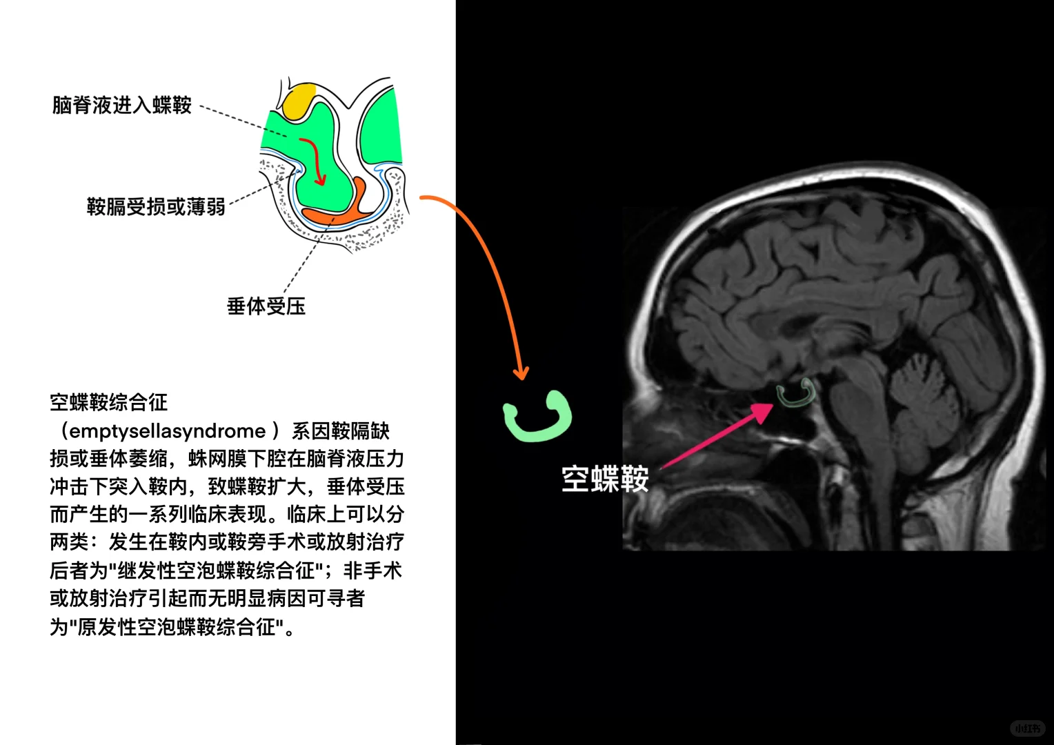 空蝶鞍与空蝶鞍综合症