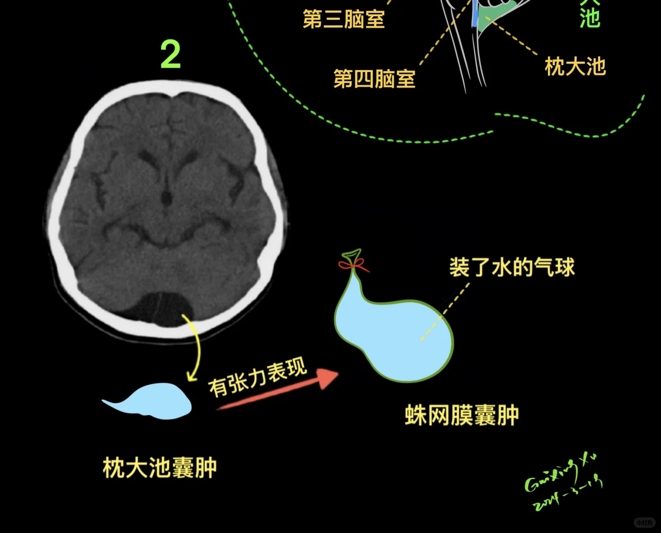 大枕大池与枕大池蛛网膜囊肿