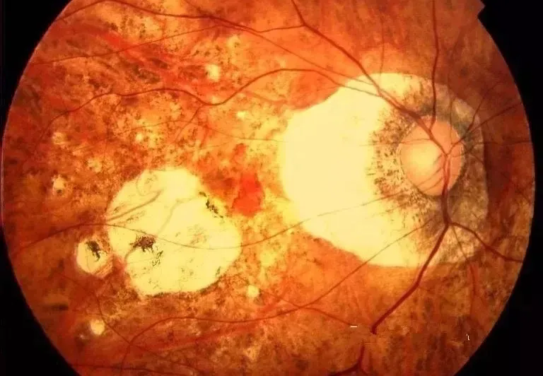 一文总结高度近视最常见眼底病变