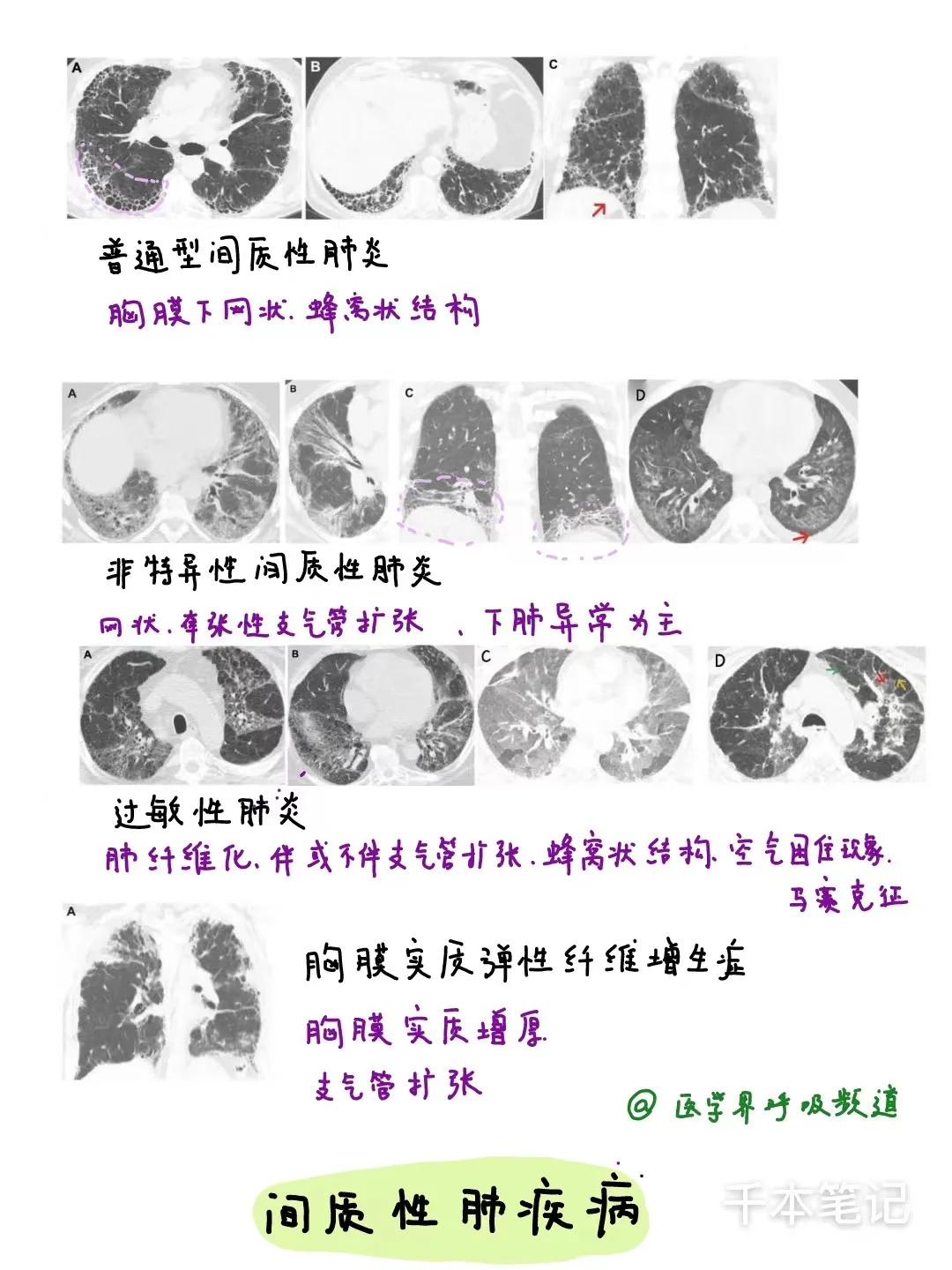 医学生绘本🎨第47弹【间质性肺病】